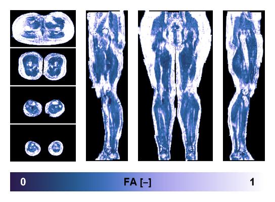 IVIM corrected whole leg muscle fractional anisotropy obtained from diffusion tensor imaging.