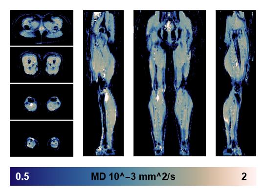 IVIM corrected whole leg muscle mean diffusivity obtained from diffusion tensor imaging.