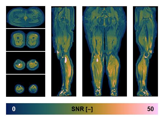 SNR distribution of the unweighted diffusion data.