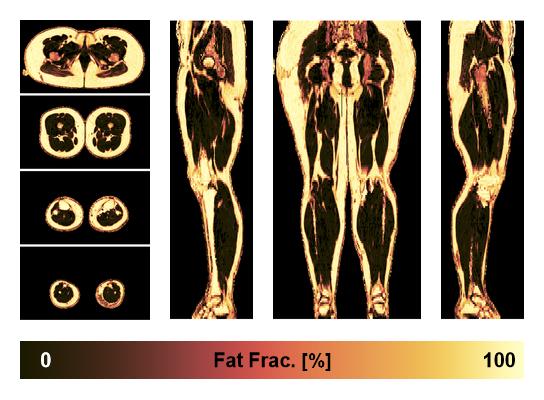 The fat fraction of the lower extremity obtained from the dixon reconstruction for muscle water fat quantification.