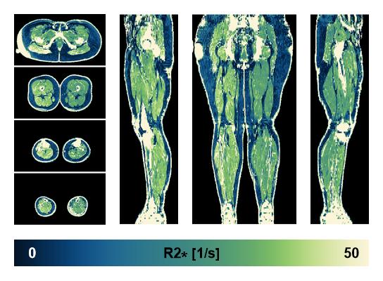 The R2 star relaxation time of the lower extremity obtained from the dixon reconstruction for muscle water fat quantification.