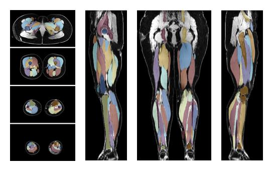 Overlay of automated muscle segmentation labels on dixon water image.