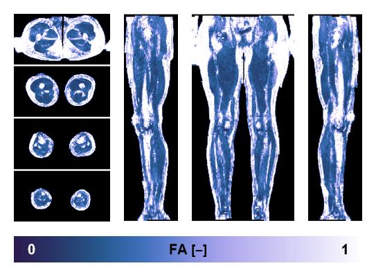 IVIM corrected whole leg muscle fractional anisotropy obtained from diffusion tensor imaging.