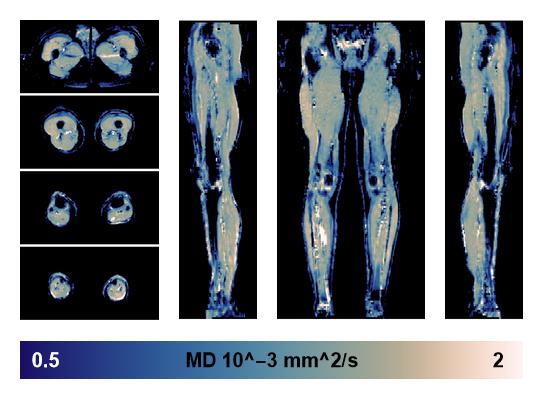 IVIM corrected whole leg muscle mean diffusivity obtained from diffusion tensor imaging.