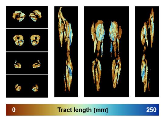 Muscle fiber tract length map based on whole leg DTI based fiber tractography.