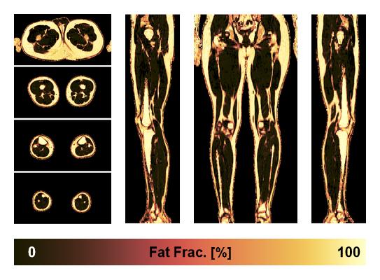 The fat fraction of the lower extremity obtained from the dixon reconstruction for muscle water fat quantification.