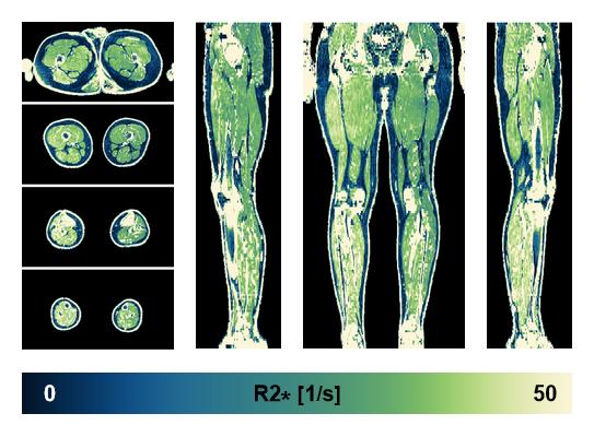 The R2 star relaxation time of the lower extremity obtained from the dixon reconstruction for muscle water fat quantification.