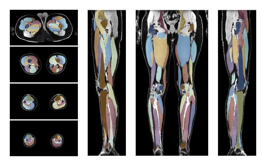 Overlay of automated muscle segmentation labels on dixon water image.