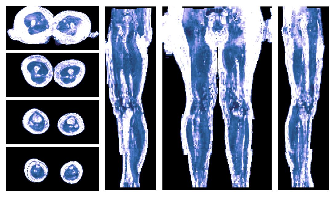 IVIM corrected whole leg muscle fractional anisotropy obtained from diffusion tensor imaging.