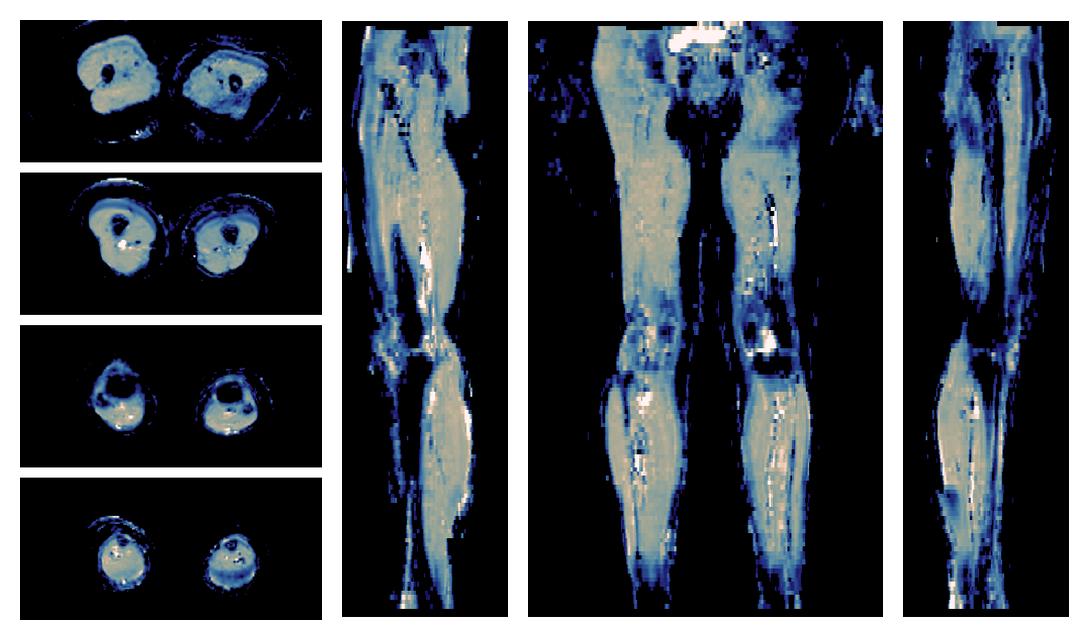 IVIM corrected whole leg muscle mean diffusivity obtained from diffusion tensor imaging.