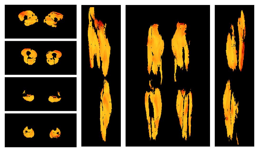 Muscle fiber tract angle map based on whole leg DTI based fiber tractography.