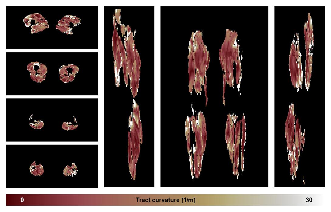 Muscle fiber tract curvature map based on whole leg DTI based fiber tractography.