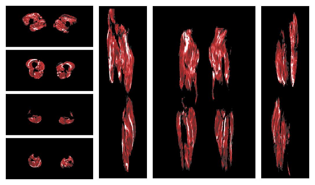 Muscle fiber tract density map based on whole leg DTI based fiber tractography.