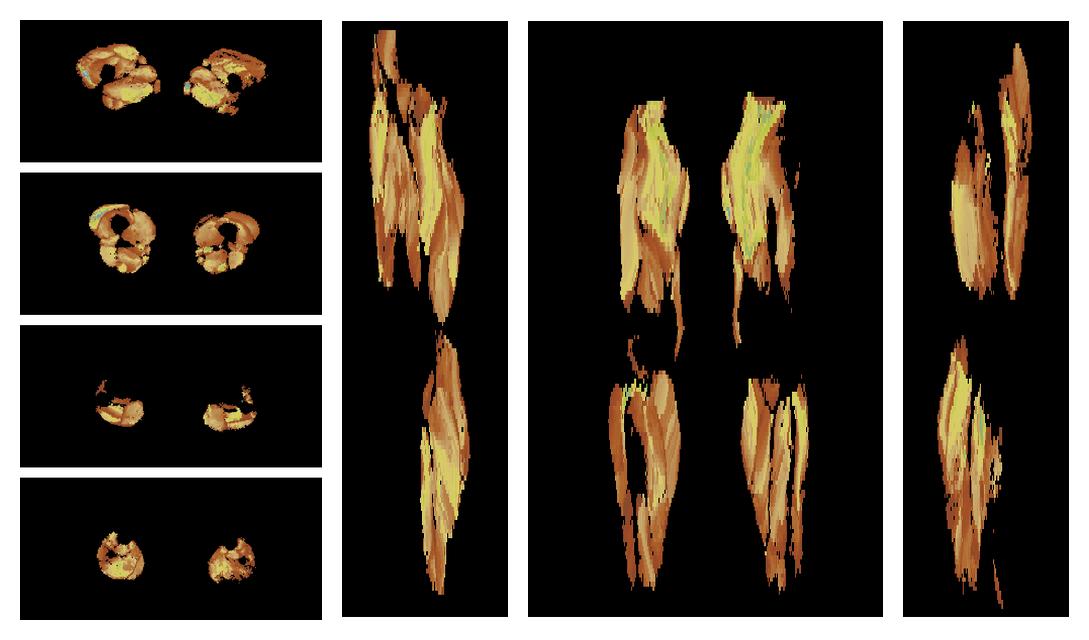 Muscle fiber tract length map based on whole leg DTI based fiber tractography.