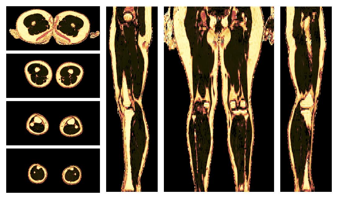 The fat fraction of the lower extremity obtained from the dixon reconstruction for muscle water fat quantification.