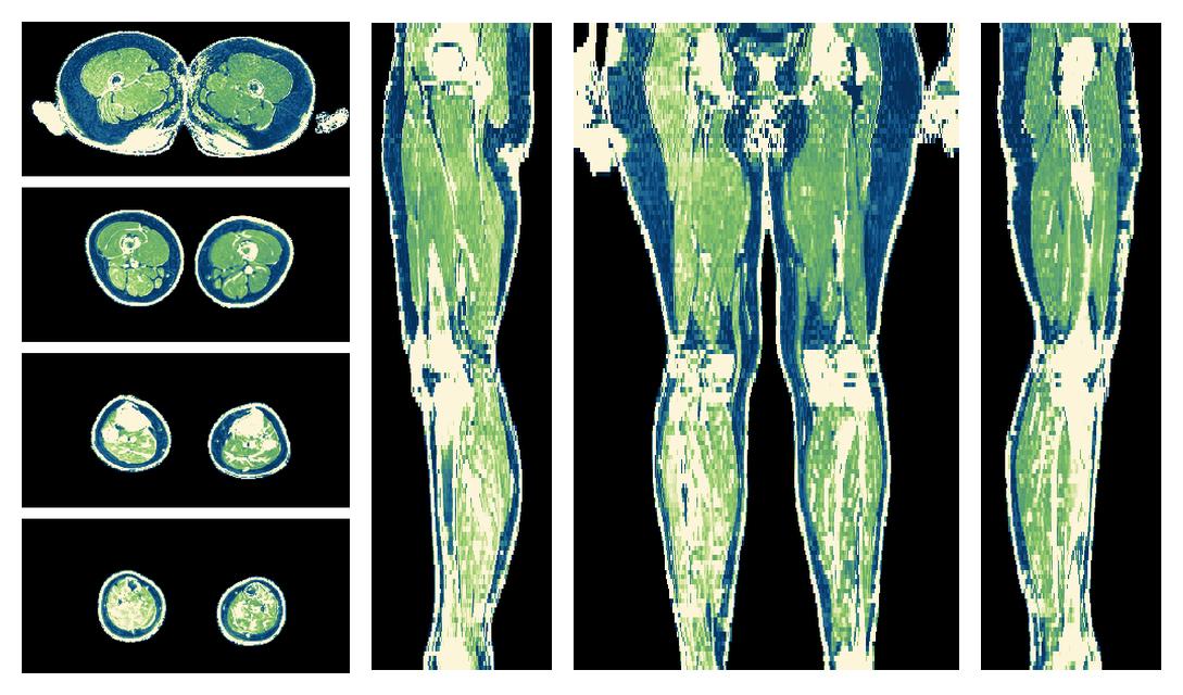 The R2 star relaxation time of the lower extremity obtained from the dixon reconstruction for muscle water fat quantification.