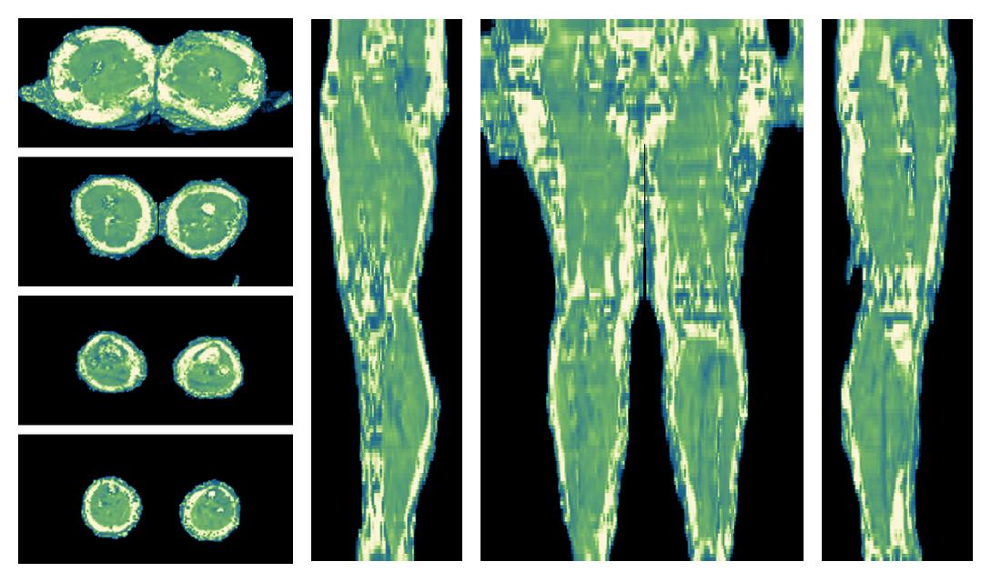 The water only T2 relaxation time of the lower extremity obtained from multi echo spin echo t2 mapping with EPG based reconstruction.