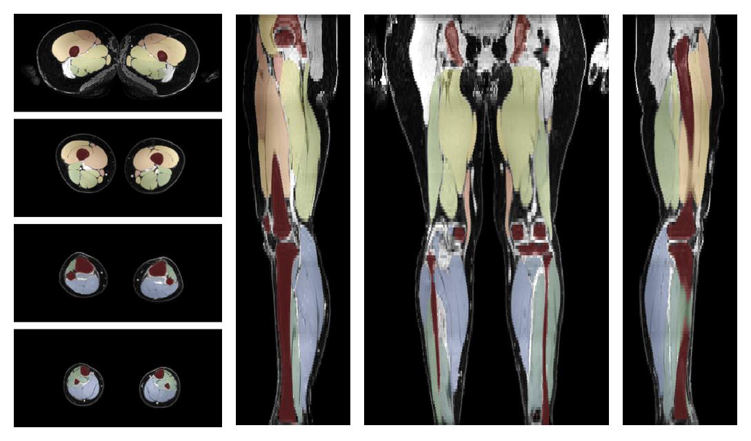 Overlay of automated muscle segmentation labels on dixon water image.