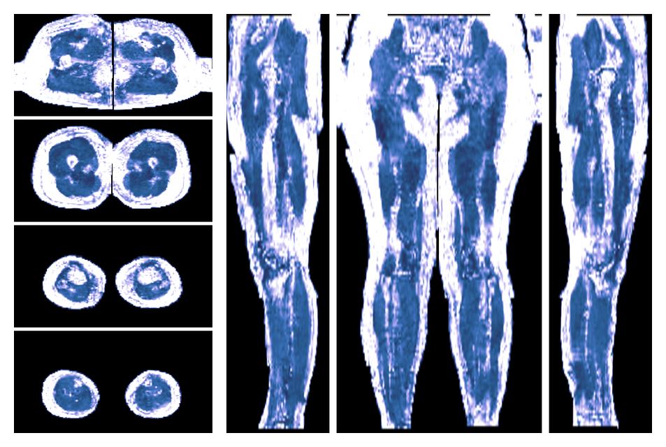 IVIM corrected whole leg muscle fractional anisotropy obtained from diffusion tensor imaging.