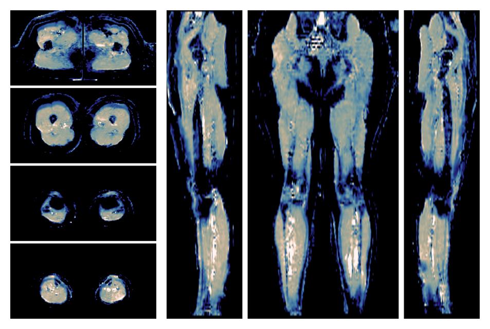 IVIM corrected whole leg muscle mean diffusivity obtained from diffusion tensor imaging.