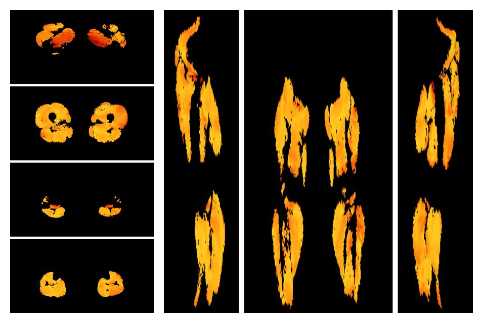 Muscle fiber tract angle map based on whole leg DTI based fiber tractography.