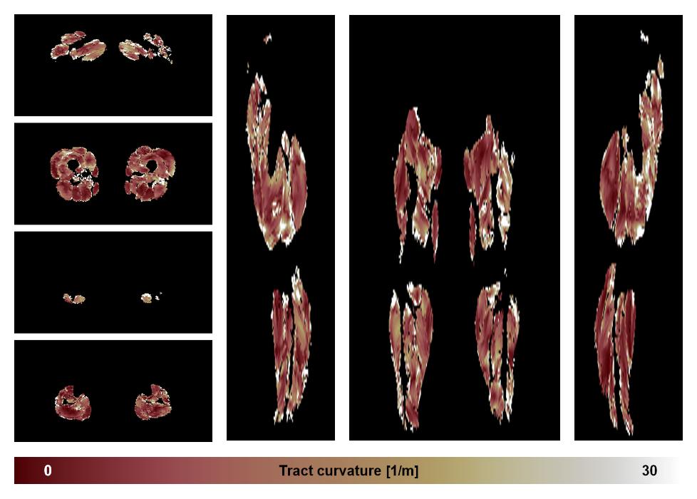 Muscle fiber tract curvature map based on whole leg DTI based fiber tractography.