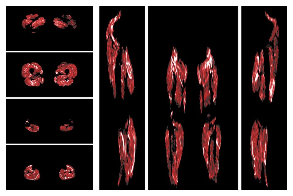 Muscle fiber tract density map based on whole leg DTI based fiber tractography.