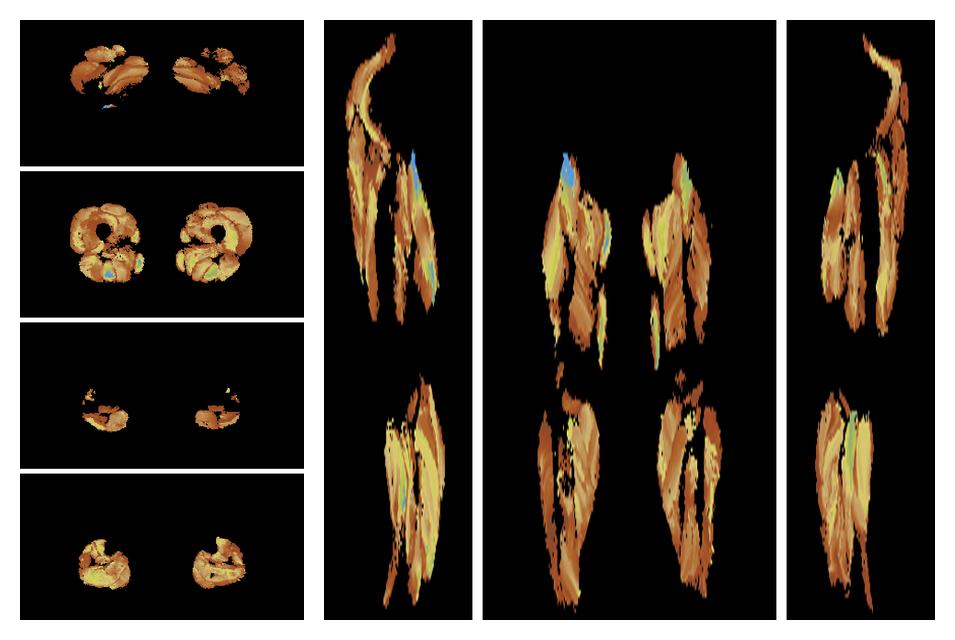 Muscle fiber tract length map based on whole leg DTI based fiber tractography.