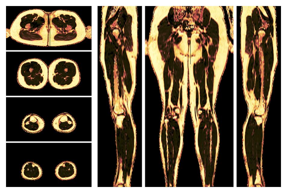 The fat fraction of the lower extremity obtained from the dixon reconstruction for muscle water fat quantification.