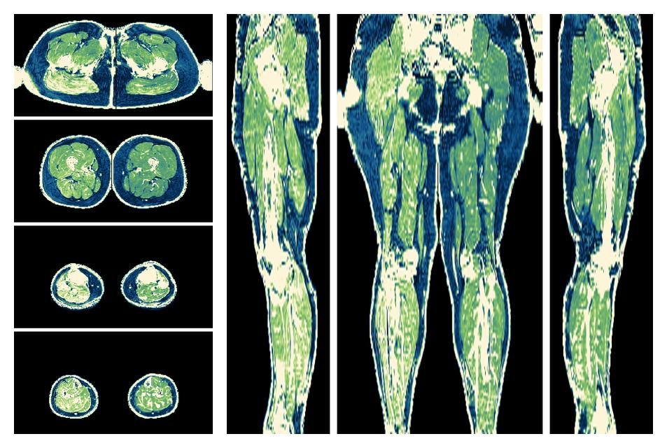 The R2 star relaxation time of the lower extremity obtained from the dixon reconstruction for muscle water fat quantification.