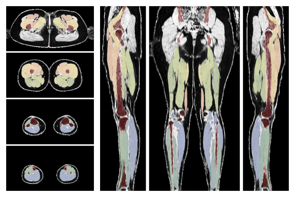 Overlay of automated muscle segmentation labels on dixon water image.