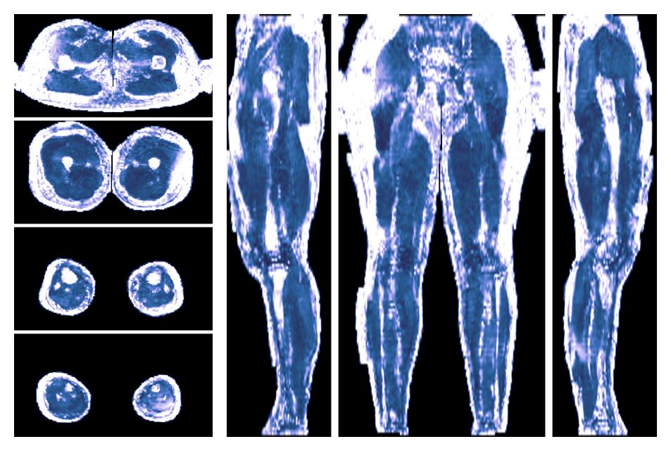 IVIM corrected whole leg muscle fractional anisotropy obtained from diffusion tensor imaging.