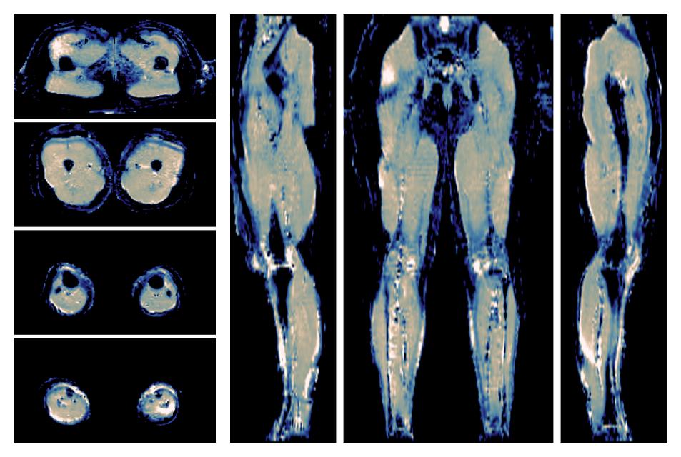 IVIM corrected whole leg muscle mean diffusivity obtained from diffusion tensor imaging.