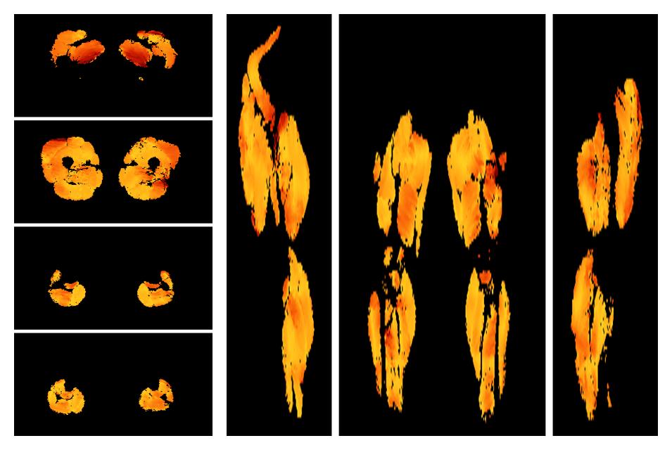 Muscle fiber tract angle map based on whole leg DTI based fiber tractography.