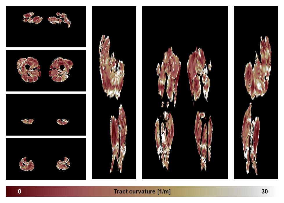 Muscle fiber tract curvature map based on whole leg DTI based fiber tractography.