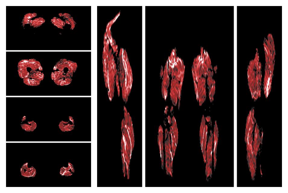 Muscle fiber tract density map based on whole leg DTI based fiber tractography.