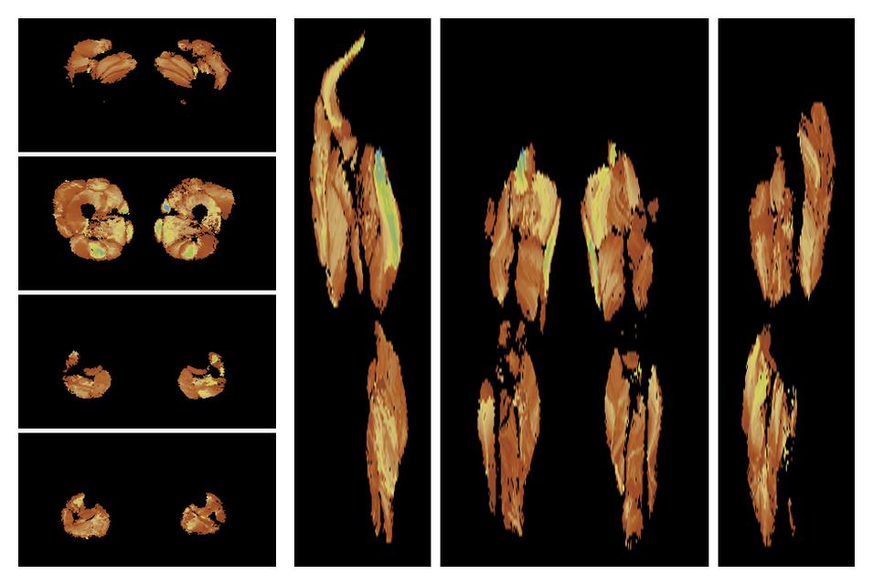 Muscle fiber tract length map based on whole leg DTI based fiber tractography.