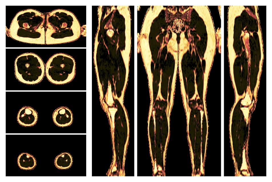 The fat fraction of the lower extremity obtained from the dixon reconstruction for muscle water fat quantification.