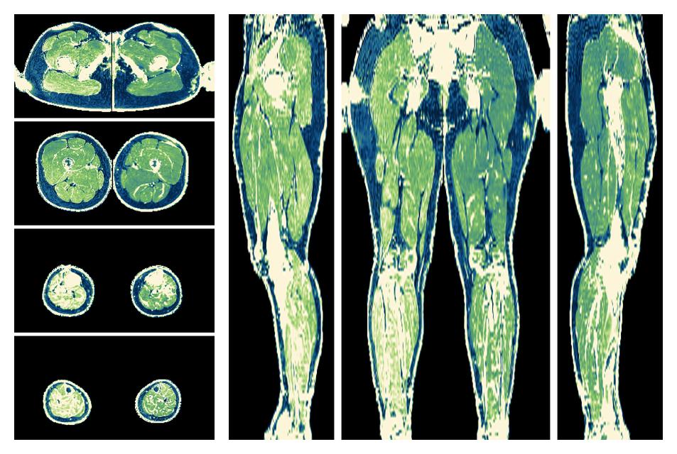 The R2 star relaxation time of the lower extremity obtained from the dixon reconstruction for muscle water fat quantification.