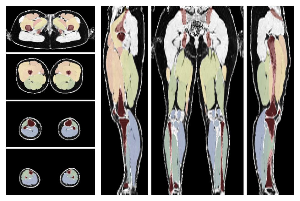 Overlay of automated muscle segmentation labels on dixon water image.