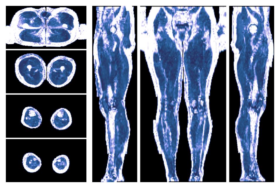 IVIM corrected whole leg muscle fractional anisotropy obtained from diffusion tensor imaging.