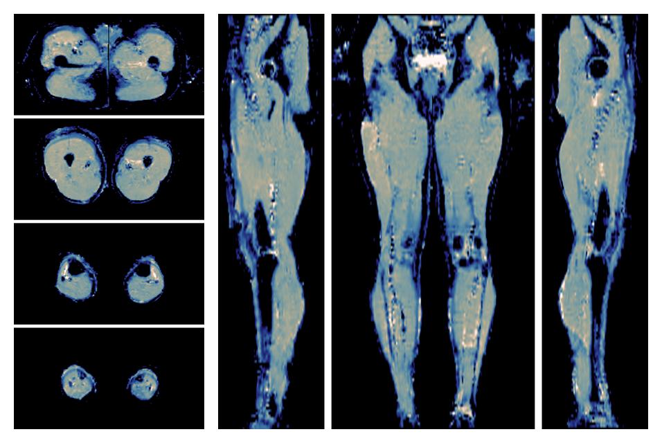 IVIM corrected whole leg muscle mean diffusivity obtained from diffusion tensor imaging.