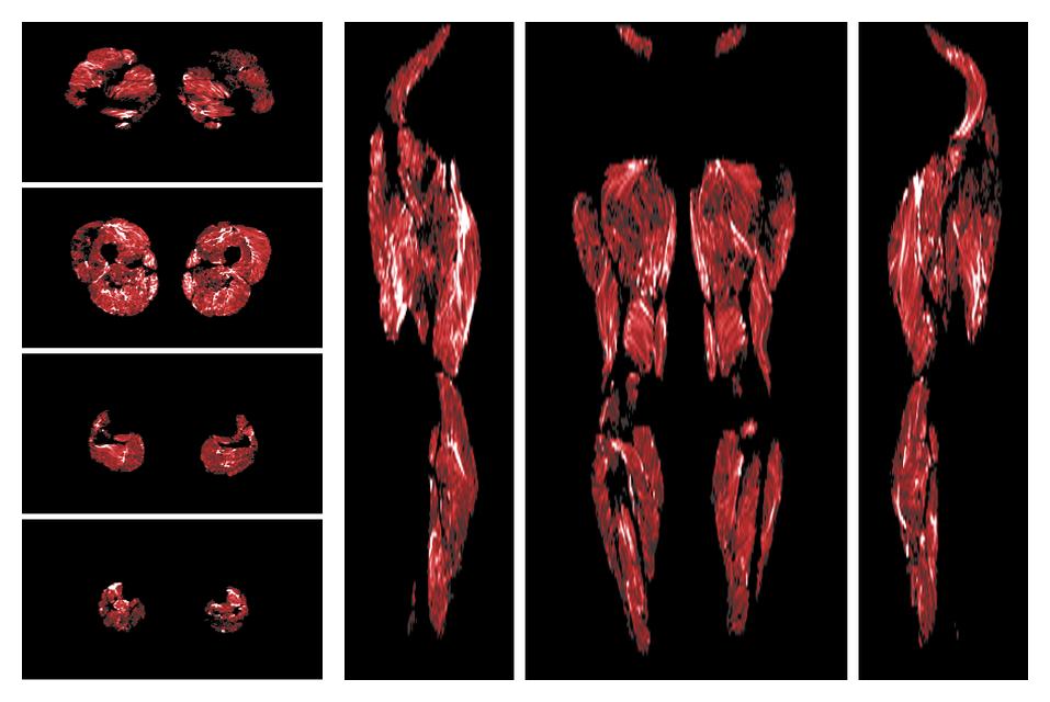 Muscle fiber tract density map based on whole leg DTI based fiber tractography.