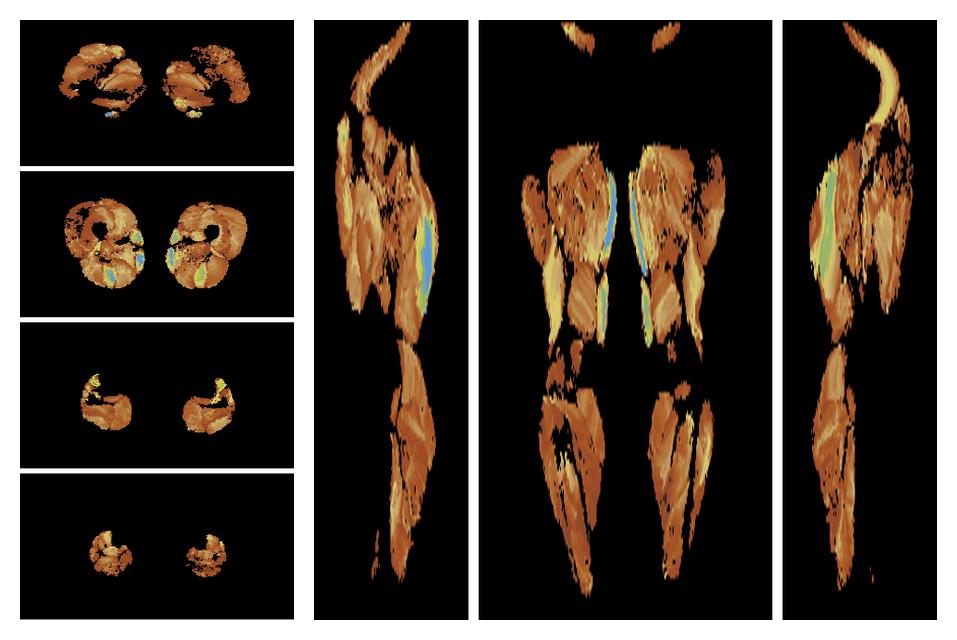 Muscle fiber tract length map based on whole leg DTI based fiber tractography.