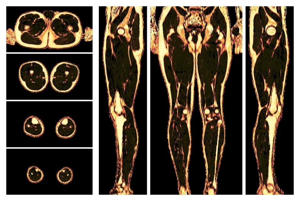 The fat fraction of the lower extremity obtained from the dixon reconstruction for muscle water fat quantification.