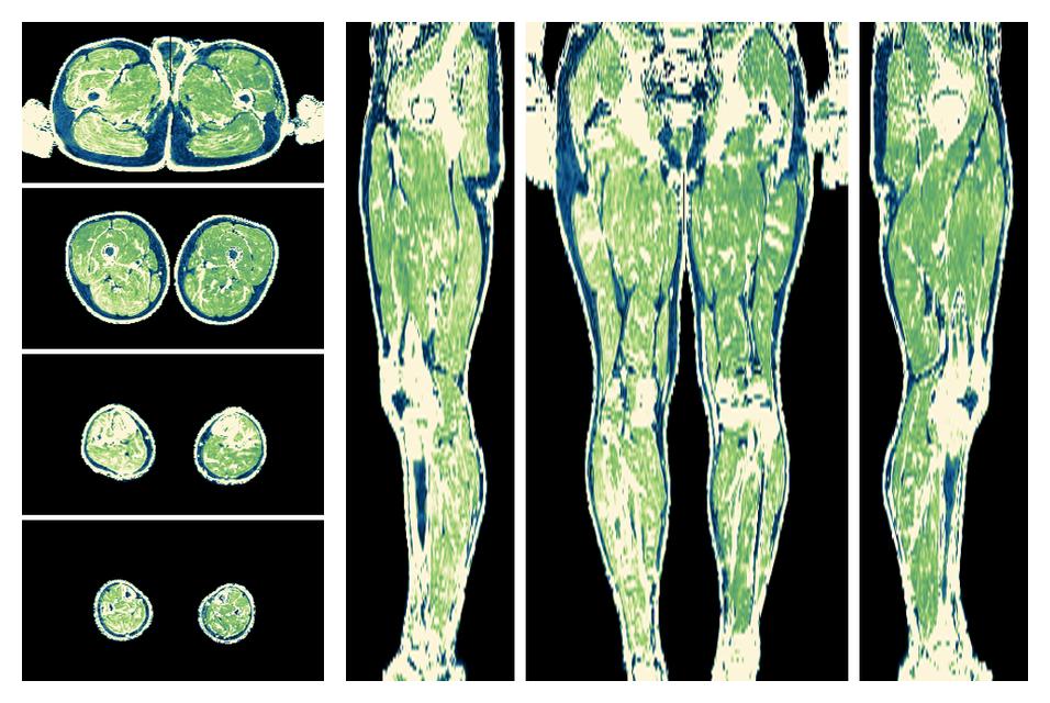 The R2 star relaxation time of the lower extremity obtained from the dixon reconstruction for muscle water fat quantification.