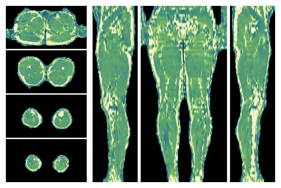 The water only T2 relaxation time of the lower extremity obtained from multi echo spin echo t2 mapping with EPG based reconstruction.