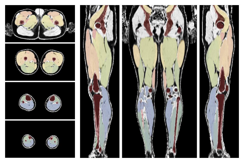 Overlay of automated muscle segmentation labels on dixon water image.