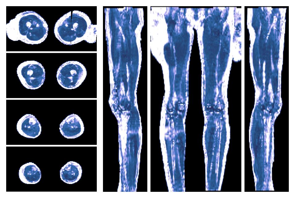 IVIM corrected whole leg muscle fractional anisotropy obtained from diffusion tensor imaging.