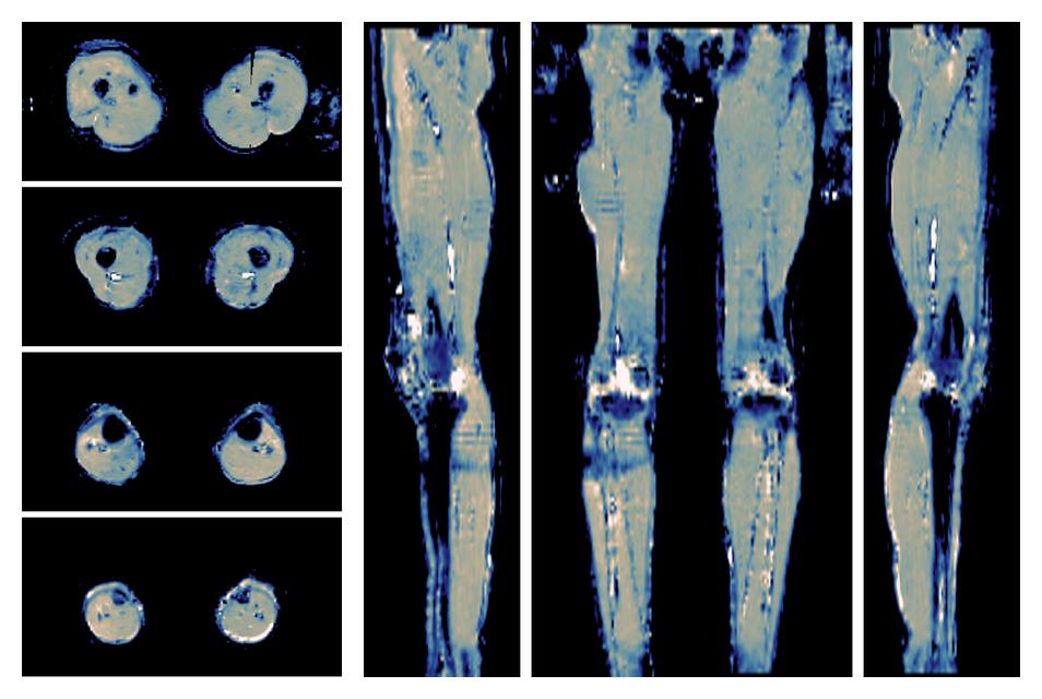 IVIM corrected whole leg muscle mean diffusivity obtained from diffusion tensor imaging.